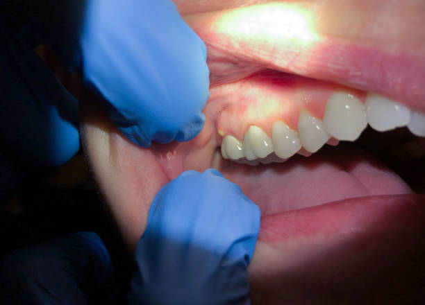 Best Emergency Dental Care for Abscessed Tooth in Loveland Park, OH